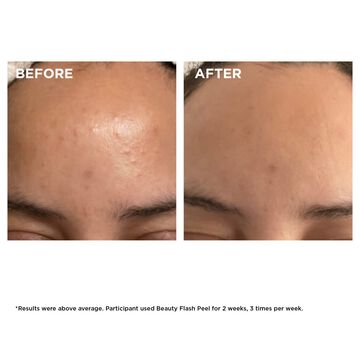 Beauty Flash Peel Face Exfoliator - At-Home Facial Skin Peel